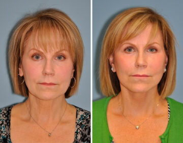 Facelift before and after at The Naderi Center, Reston, VA and Chevy Chase, MD, Patient 8899