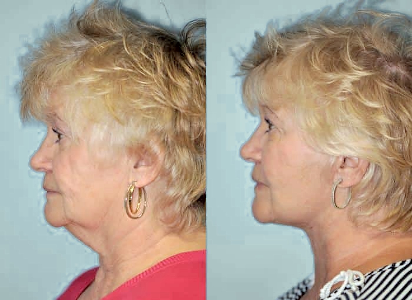 Before and after facelift, side profile: neck laxity and jowls
