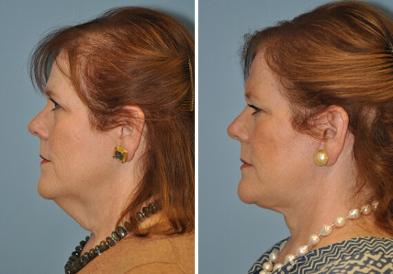 Facelift before and after, Patient 8903
