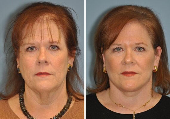 Facelift before and after, Patient 8903