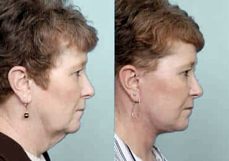 Before and after facelift, side profile: jowls and fullness under the chin