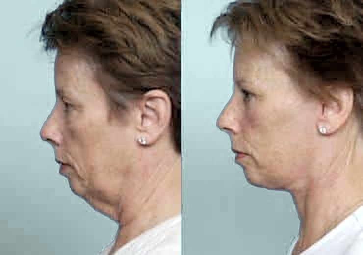 Before and after facelift, side profile: severe jowls and a full neck