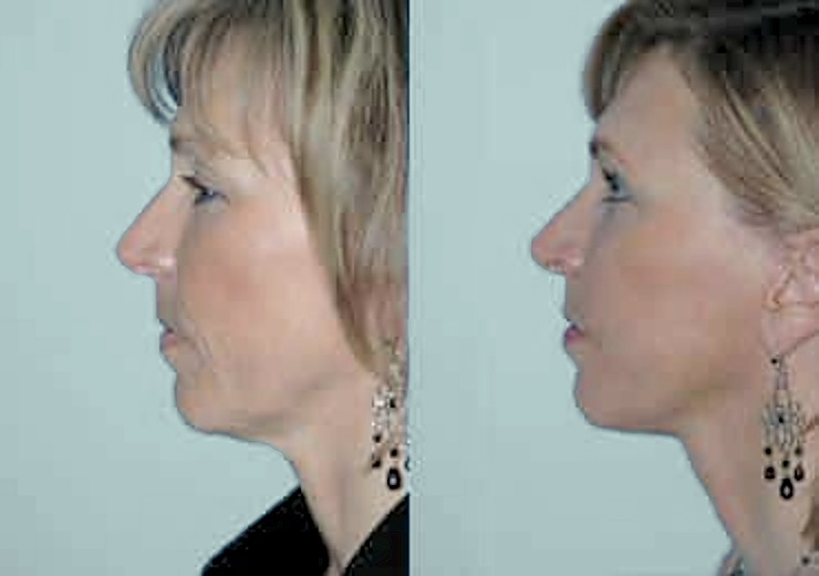 Before and after facelift and neck lift, side profile: a cleaner jawline and neck