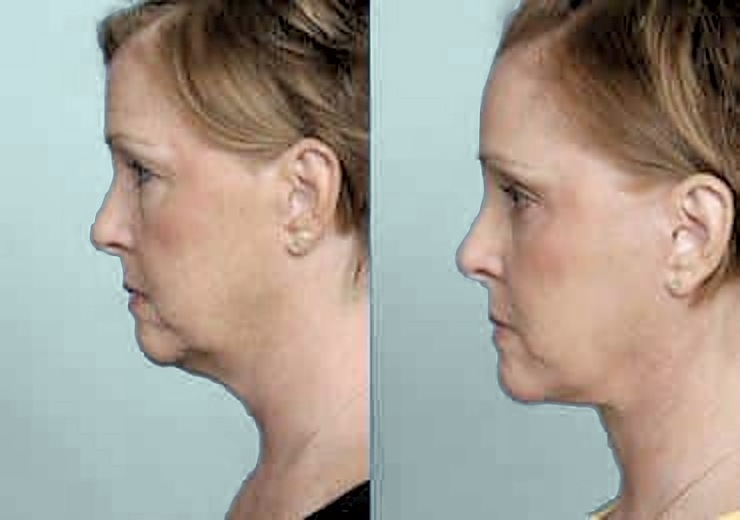 Before and after facelift, side profile: jowls, neck fullness and heavy eyelids