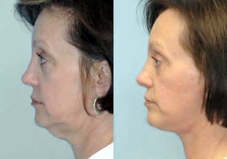 Before and after facelift, side profile: a smoother neck and jawline