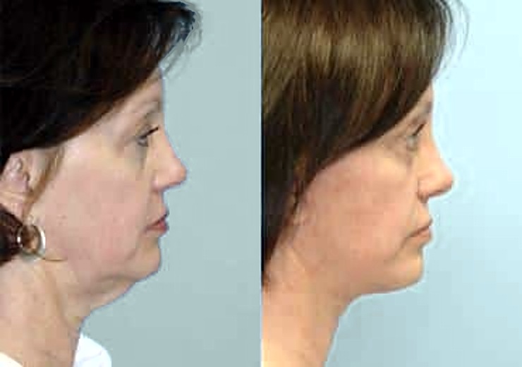 Before and after facelift and neck lift, side profile: a smoother neck and jawline