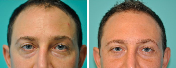 Blepharoplasty before and after at The Naderi Center, Reston, VA and Chevy Chase, MD, Patient 8920