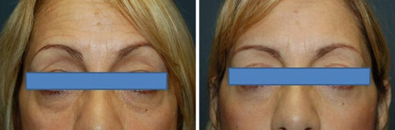 Blepharoplasty before and after at The Naderi Center, Reston, VA and Chevy Chase, MD, Patient 8921