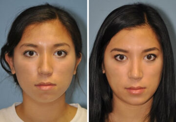 Chin & Facial Implant before and after at The Naderi Center, Reston, VA and Chevy Chase, MD, Patient 8929