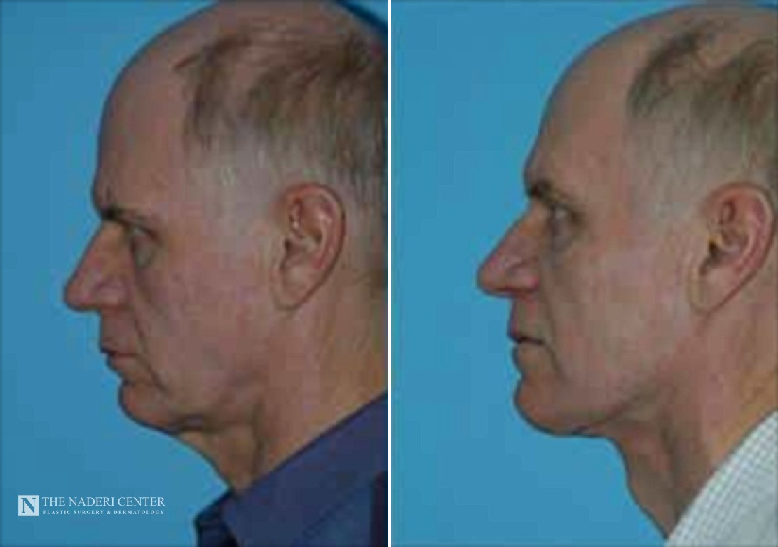 Before and after Neck Lift by Dr. Shervin Naderi, Patient 8939