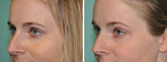Skin Resurfacing before and after at The Naderi Center, Reston, VA and Chevy Chase, MD, Patient 8941
