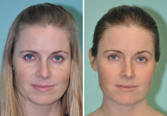 Skin Resurfacing before and after at The Naderi Center, Reston, VA and Chevy Chase, MD, Patient 8941