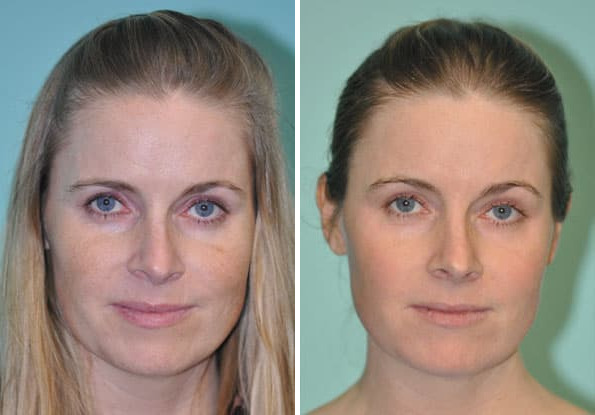 Before and after Skin Resurfacing by Dr. Shervin Naderi, Patient 8941