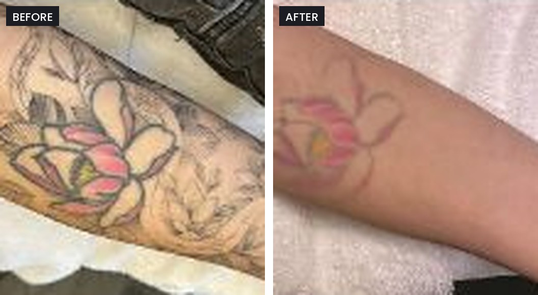 Pico Majesty before and after: black and pink tattoo on the forearm, with most of the black shading faded after treatment