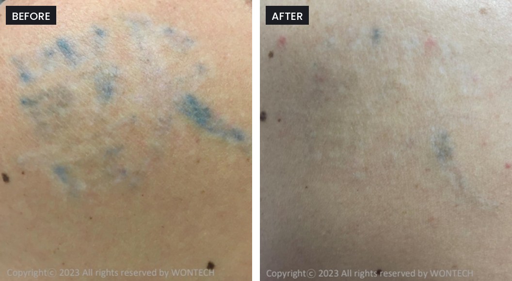 Pico Majesty before and after: blue ink tattoo on the back, largely faded after treatment