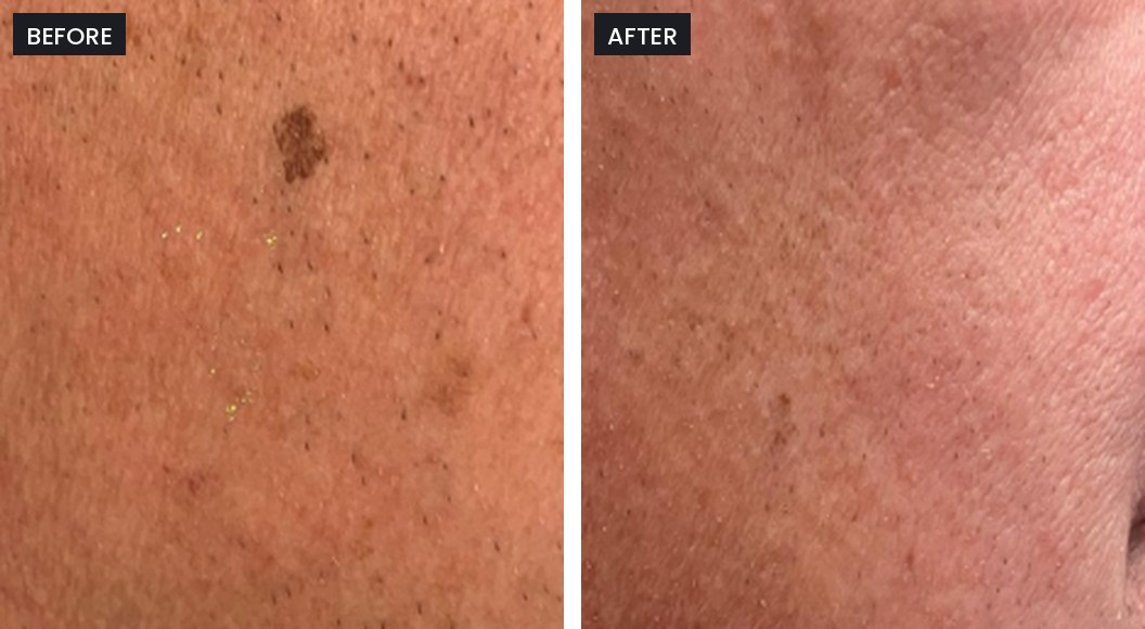 Pico Majesty before and after: a dark brown spot on the cheek, faded after treatment