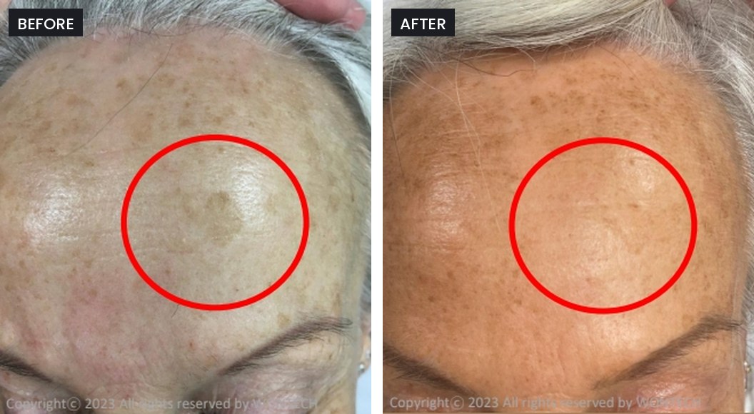 Pico Majesty before and after: a sun spot on the forehead, faded after treatment