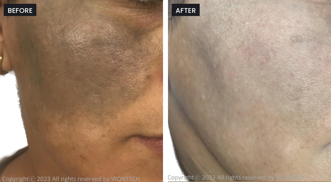 Pico Majesty before and after: dark pigmentation across the cheek in deeper skin, visibly lighter after treatment