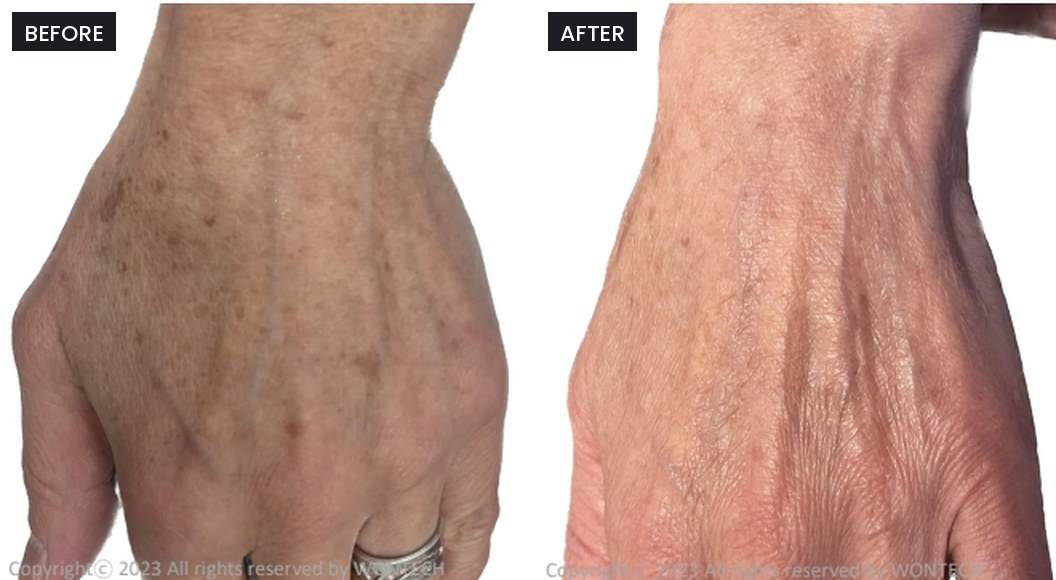 Pico Majesty before and after: sun spots on the back of the hand, faded after treatment