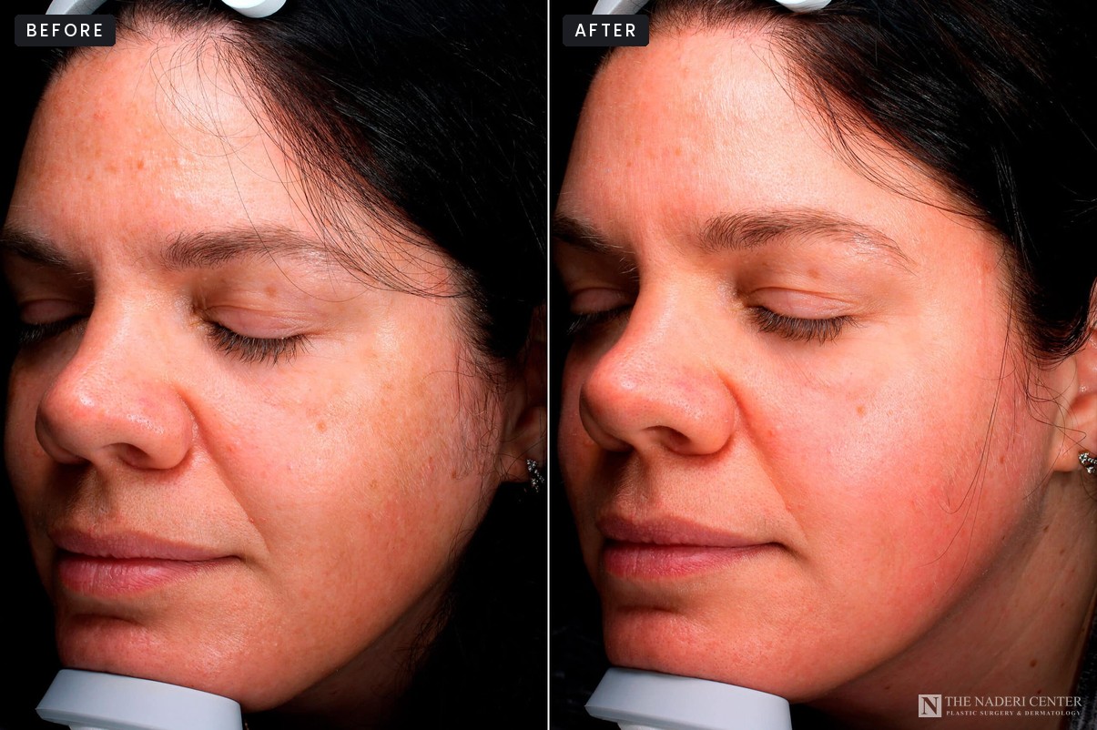 Before and after three VI Precision Purify peels for facial pigmentation, The Naderi Center