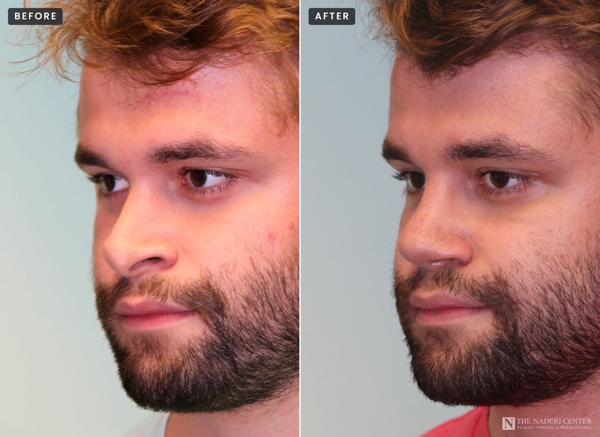 Revision rhinoplasty before and after, three-quarter view of a man whose nose was over-reduced by two earlier surgeries (left), and after Dr. Shervin Naderi rebuilt the bridge and lifted the tip (right)