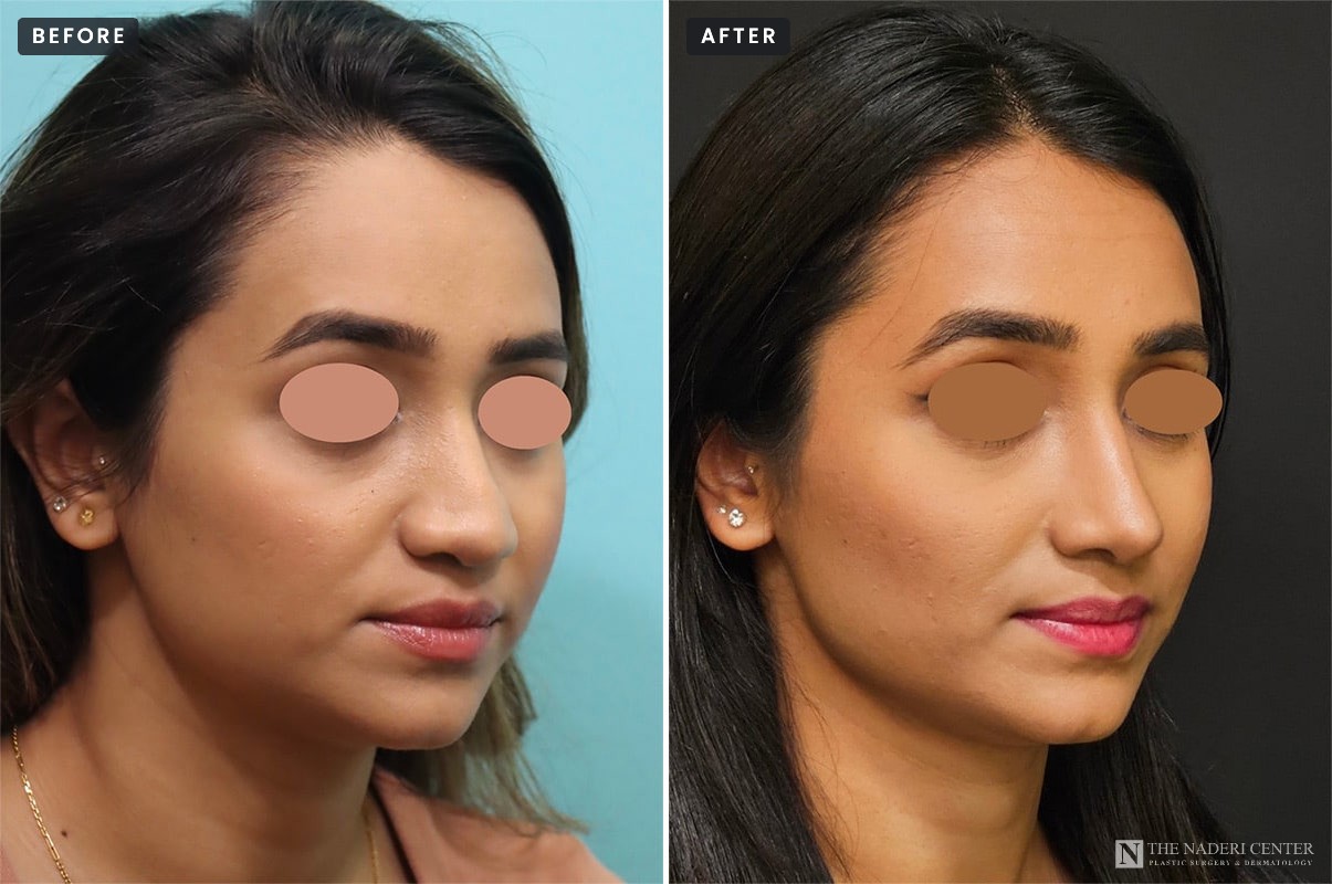 Revision rhinoplasty before and after, three-quarter view: a weak, asymmetric nose before (left), and a more defined, symmetric nose after rib cartilage reconstruction by Dr. Shervin Naderi (right)