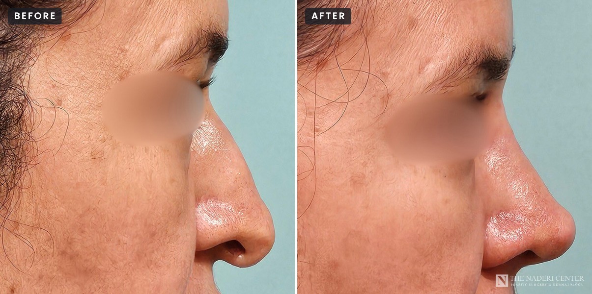 Revision rhinoplasty before and after, side view: a twisted nose with a drooping tip before (left), and a straighter, better supported nose four months after revision surgery by Dr. Shervin Naderi (right)