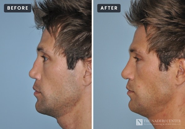 Revision rhinoplasty before and after, side view of a man with several earlier nose surgeries and sports injuries (left), and after reconstruction by Dr. Shervin Naderi (right)