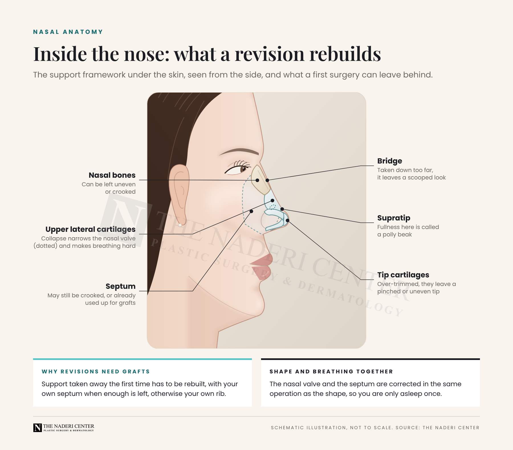 Labeled side-view illustration of the nose showing the nasal bones, upper lateral cartilages, nasal valve, septum, bridge, supratip and tip cartilages, and what a first rhinoplasty can leave behind at each