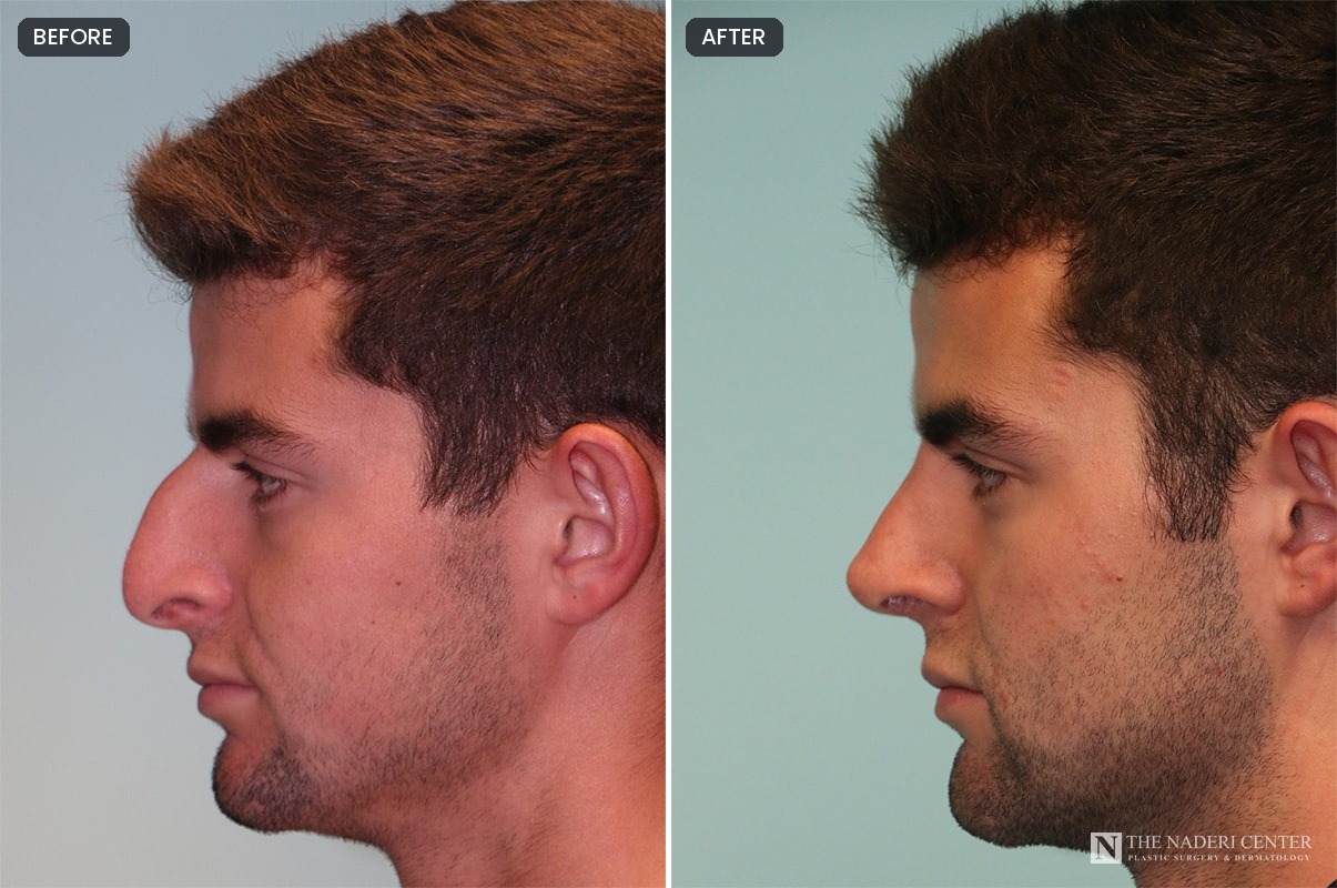 Male rhinoplasty before and after by Dr. Shervin Naderi, side profile showing a reduced dorsal hump and a natural, masculine nose
