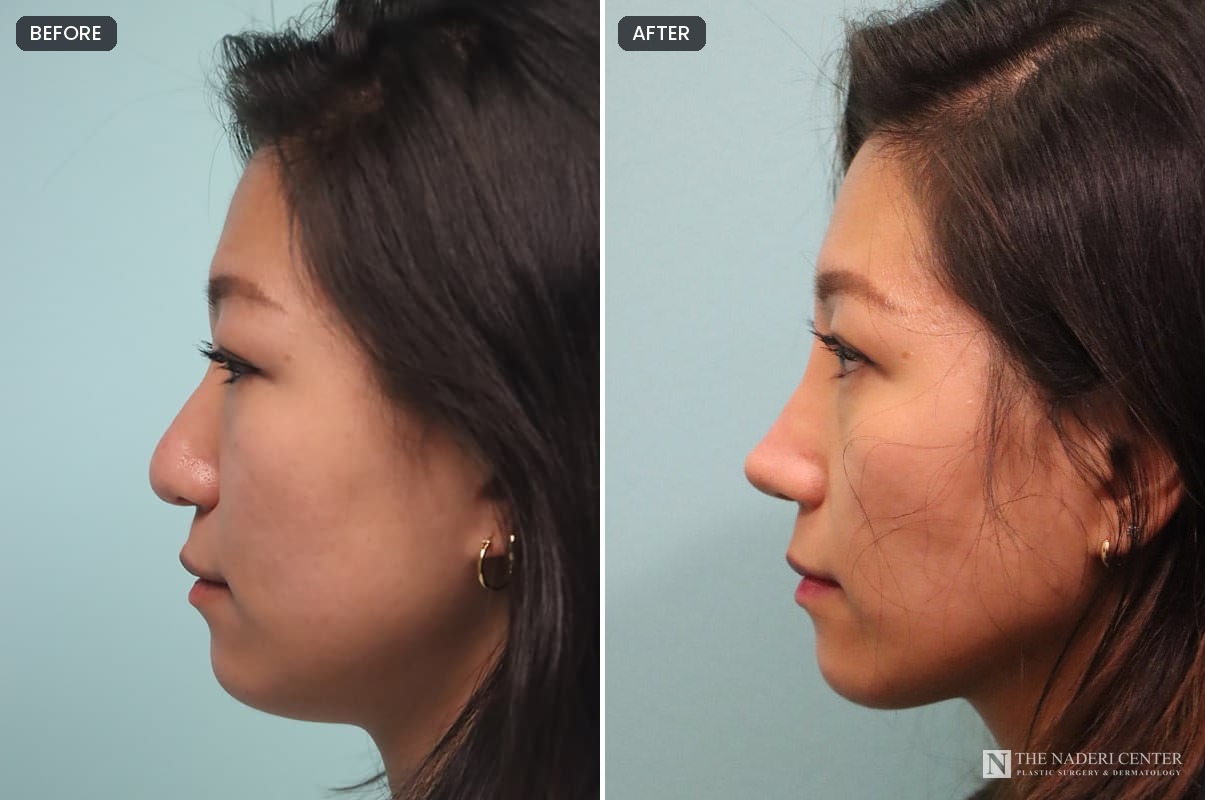 Thick skin rhinoplasty before and after by Dr. Shervin Naderi, side profile one month after surgery with a more defined tip