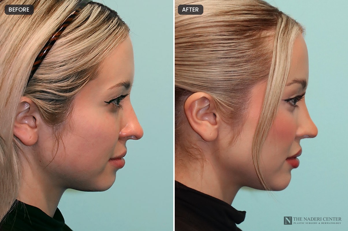 Subtle rhinoplasty before and after by Dr. Shervin Naderi, side profile of a young woman with a natural nose that fits her face