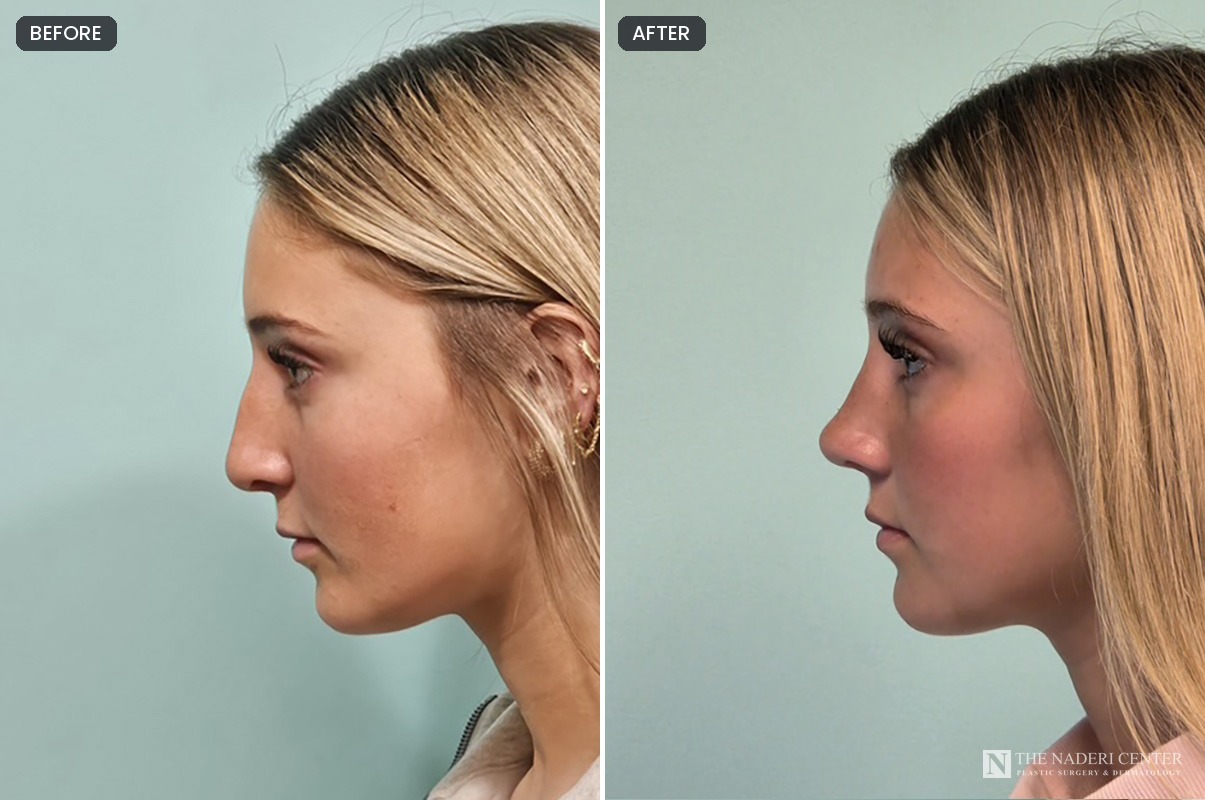 Rhinoplasty before and after by Dr. Shervin Naderi, side profile of a young woman with a lowered bridge and refined tip