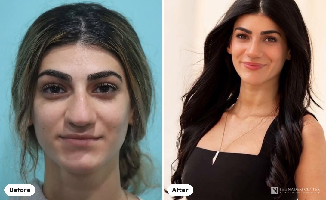 Rhinoplasty before and after, real patient at The Naderi Center in Reston, VA and Chevy Chase, MD