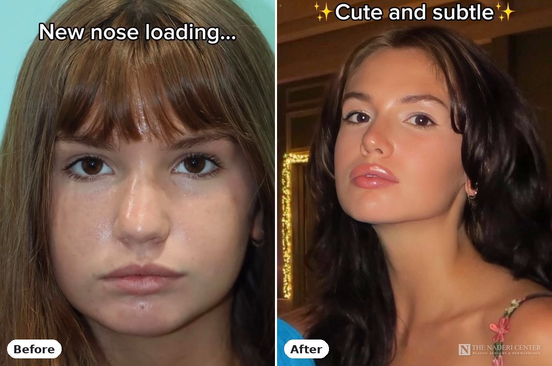 Rhinoplasty before and after, real patient at The Naderi Center in Reston, VA and Chevy Chase, MD