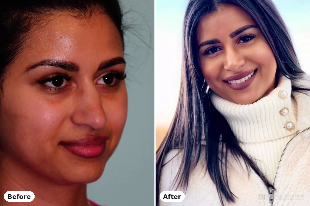 Rhinoplasty before and after, real patient at The Naderi Center in Reston, VA and Chevy Chase, MD