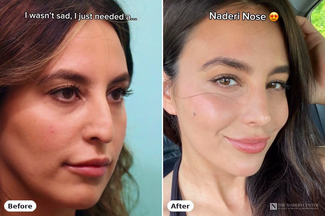 Rhinoplasty before and after, real patient at The Naderi Center in Reston, VA and Chevy Chase, MD