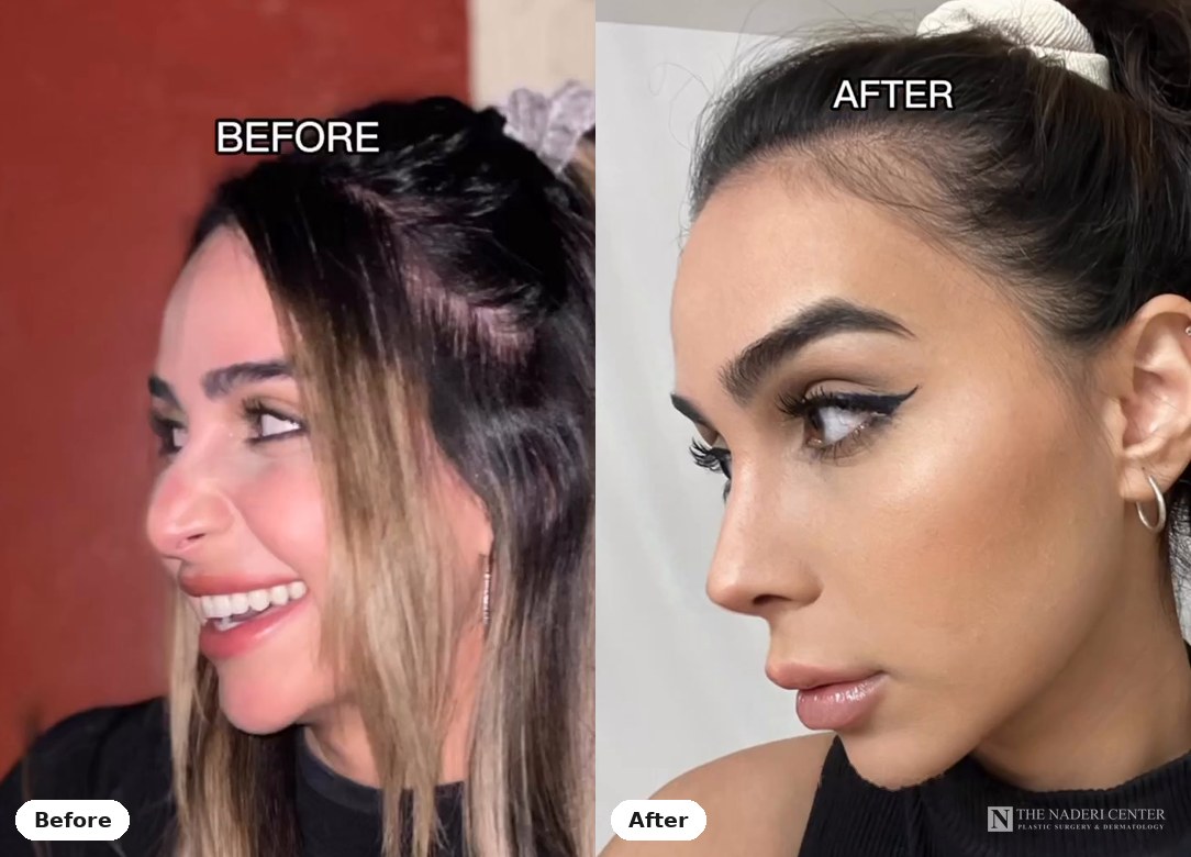 Rhinoplasty before and after, real patient at The Naderi Center in Reston, VA and Chevy Chase, MD