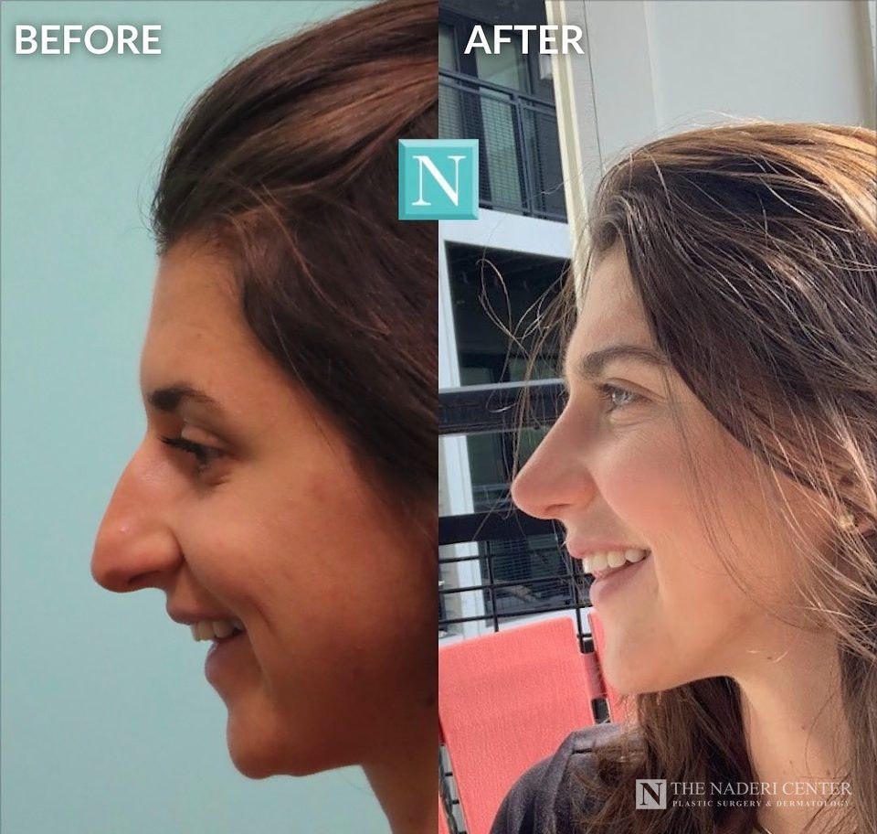 Rhinoplasty before and after, real patient at The Naderi Center in Reston, VA and Chevy Chase, MD