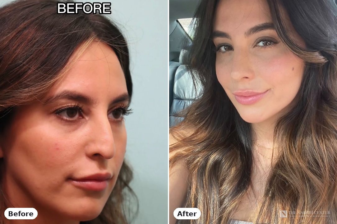 Rhinoplasty before and after, real patient at The Naderi Center in Reston, VA and Chevy Chase, MD