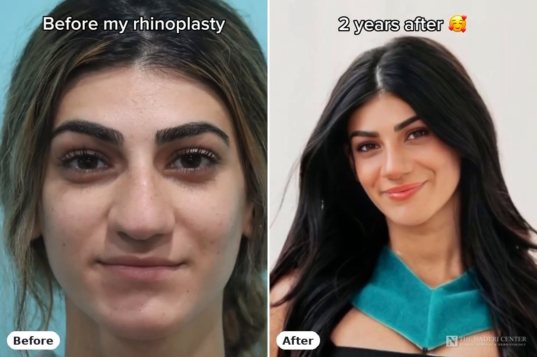 Rhinoplasty before and after, real patient at The Naderi Center in Reston, VA and Chevy Chase, MD