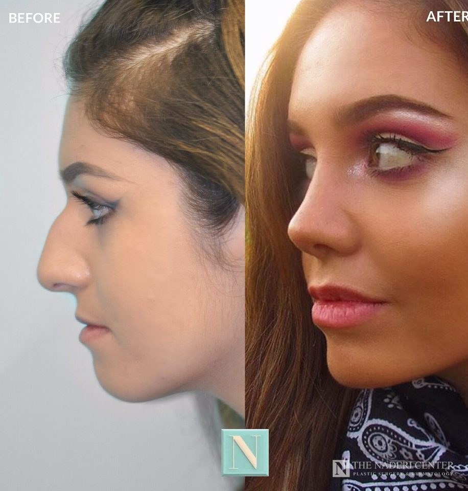 Rhinoplasty before and after, real patient at The Naderi Center in Reston, VA and Chevy Chase, MD