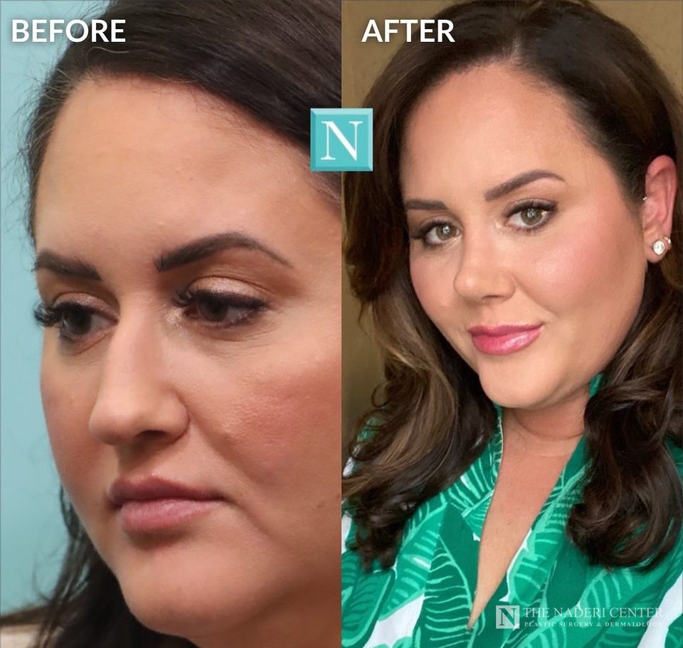 Rhinoplasty before and after, real patient at The Naderi Center in Reston, VA and Chevy Chase, MD