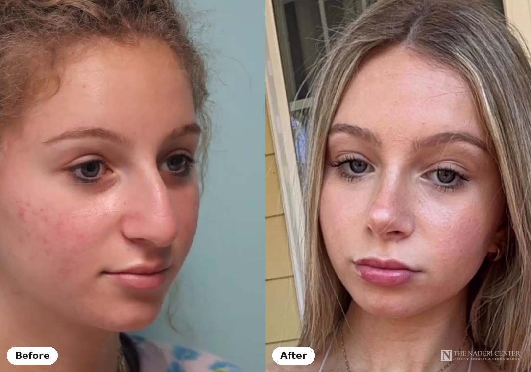 Rhinoplasty before and after, real patient at The Naderi Center in Reston, VA and Chevy Chase, MD