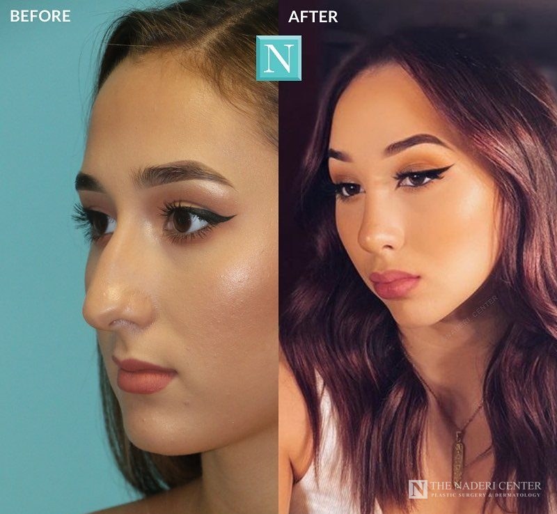 Rhinoplasty before and after, real patient at The Naderi Center in Reston, VA and Chevy Chase, MD