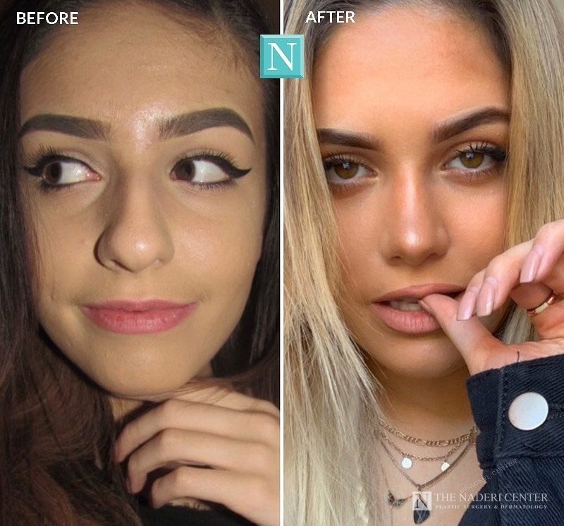 Rhinoplasty before and after, real patient at The Naderi Center in Reston, VA and Chevy Chase, MD