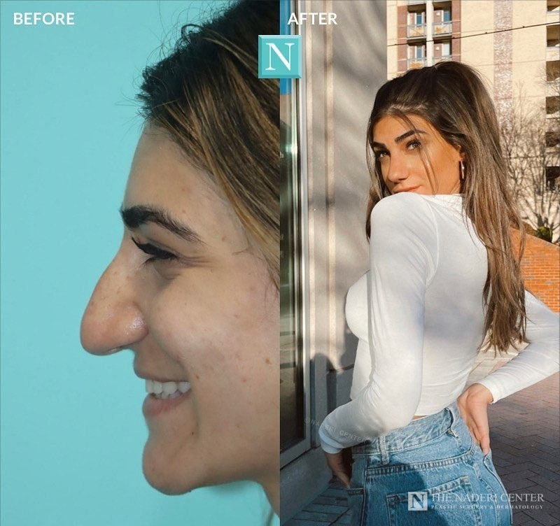 Rhinoplasty before and after, real patient at The Naderi Center in Reston, VA and Chevy Chase, MD