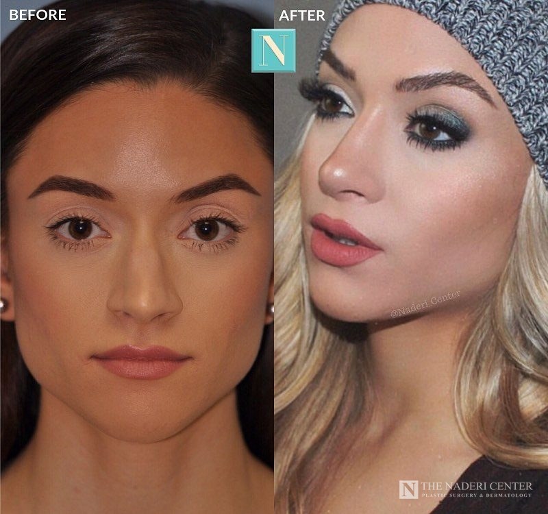Rhinoplasty before and after, real patient at The Naderi Center in Reston, VA and Chevy Chase, MD