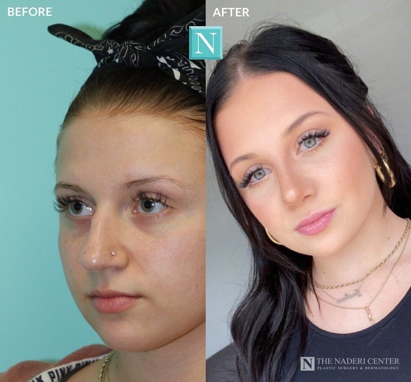 Rhinoplasty before and after, real patient at The Naderi Center in Reston, VA and Chevy Chase, MD