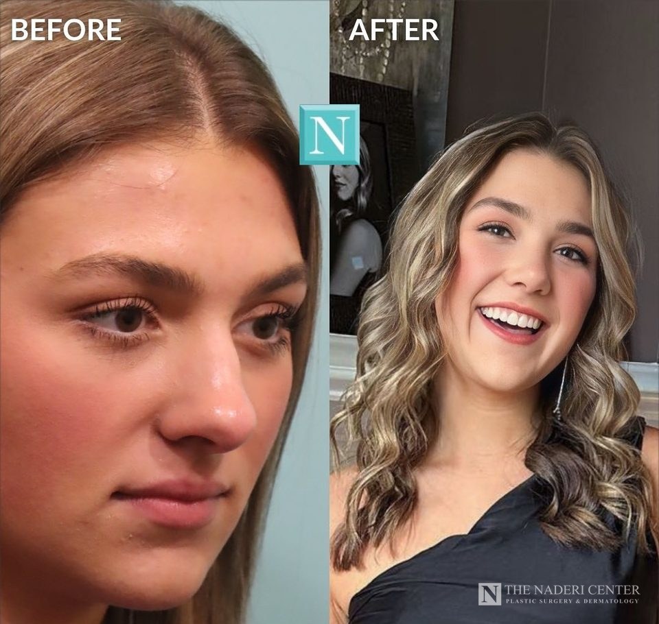 Rhinoplasty before and after, real patient at The Naderi Center in Reston, VA and Chevy Chase, MD